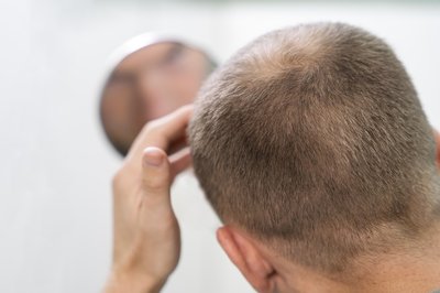 �Qu� es la alopecia areata?