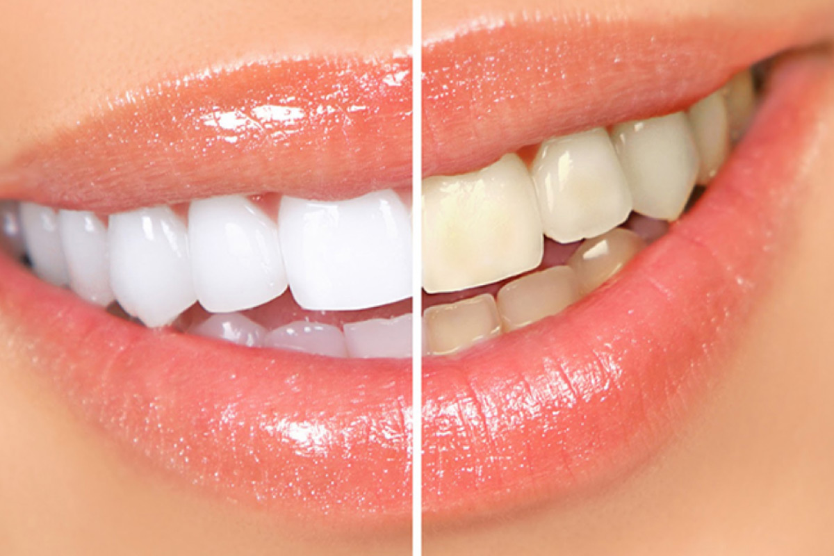 Blanqueamiento dental en Cl�nica Tornel