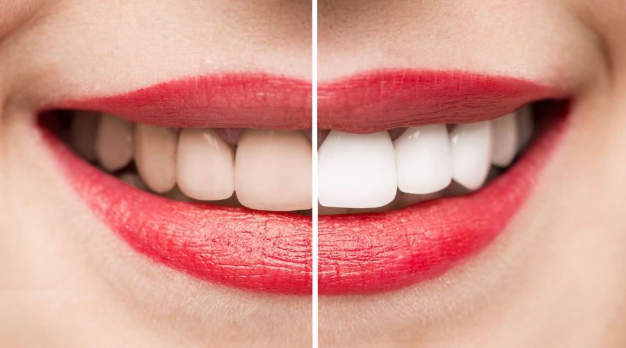 �Cu�nto cuesta un blanqueamiento dental en Ecuador?