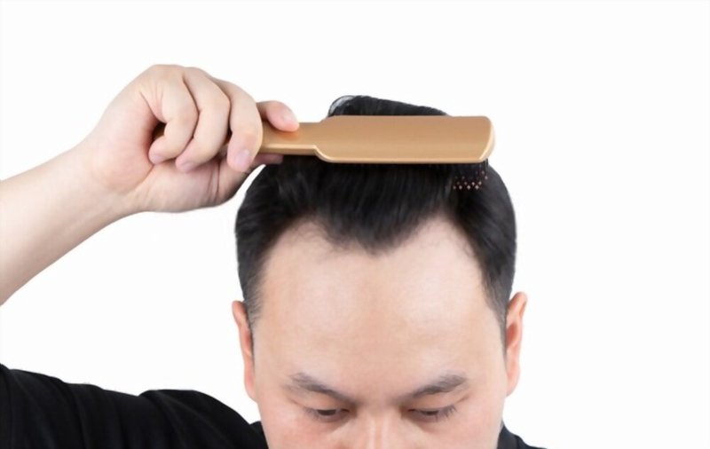 Implantes Capilares: Una Soluci�n Eficaz para la P�rdida de Cabello